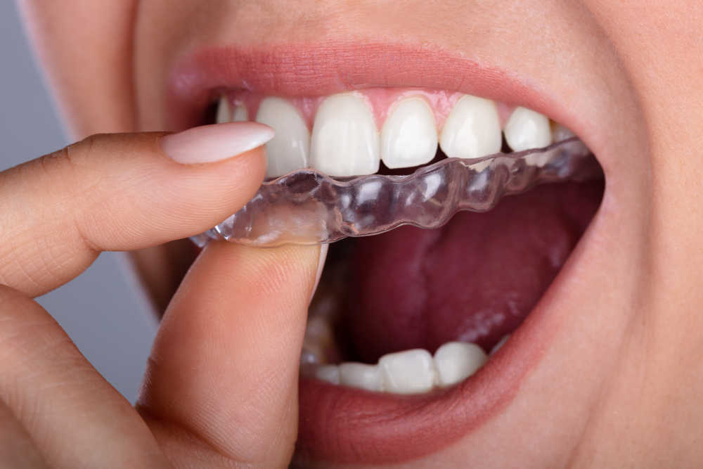 Las ventajas e inconvenientes de la ortodoncia invisible